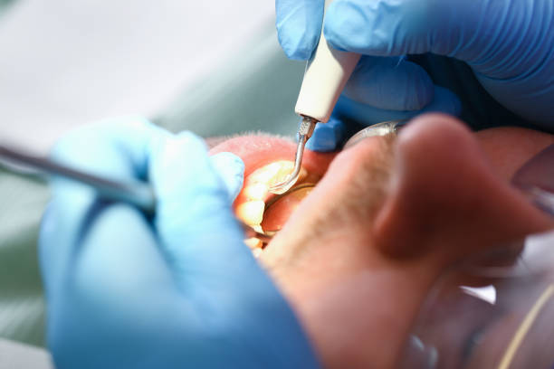 Best Emergency Treatment for Dental Infections or Abscesses in Four Oaks, NC